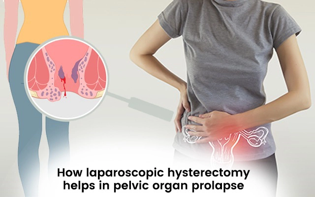 How Laparoscopic Hysterectomy Helps in Pelvic Organ Prolapse