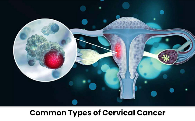 Common Types of Cervical Cancer