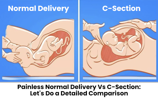 Painless Normal Delivery Vs C-Section