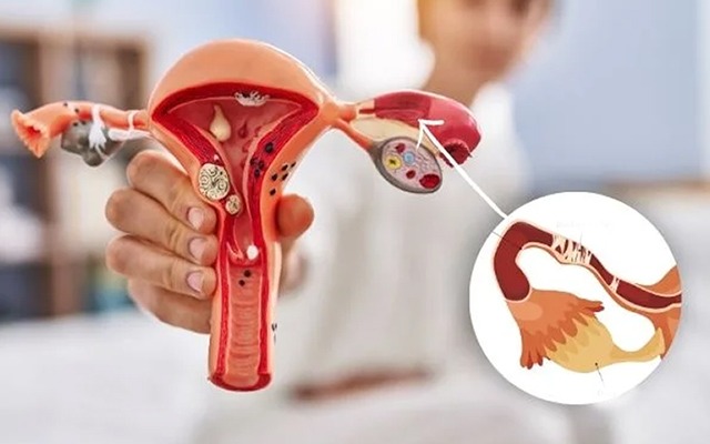 Blocked Fallopian Tubes