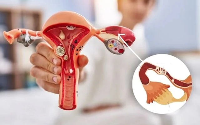 Blocked Fallopian Tubes & Female Infertility: Causes, Symptoms, Diagnosis & Treatment